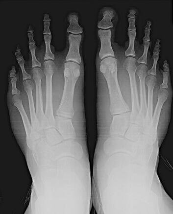 The Middle Toe of the Right Foot by Ambrose Bierce